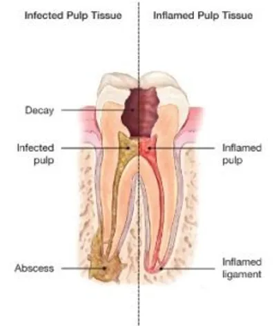 A cross section of the tooth shows the various stages of decay, pulp and abscess.