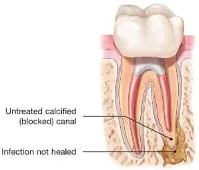 A tooth is shown with the root canal being blocked.