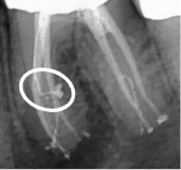 A picture of an x-ray showing the location of a tooth.