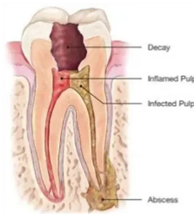 A tooth is shown with the root canal being removed.