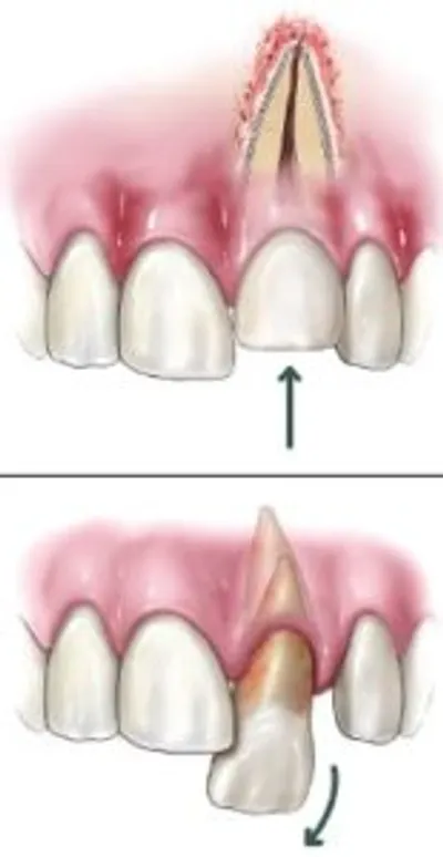 A before and after picture of the process of tooth filling.