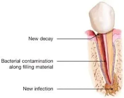 A tooth with decay and infection labeled.