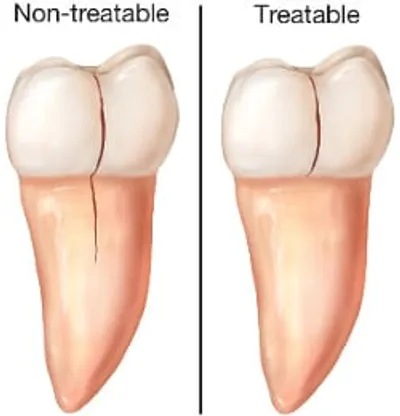 A tooth with no teeth and one without it.