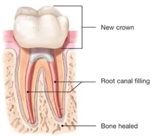 A cross section of the tooth shows new crown, root canal filling and bone healed.
