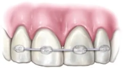 A close up of an upper part of teeth with braces