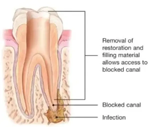 A tooth is shown with the root canal removed.
