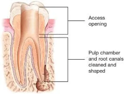 A cross section of the tooth shows how it is cleaned and shaped.