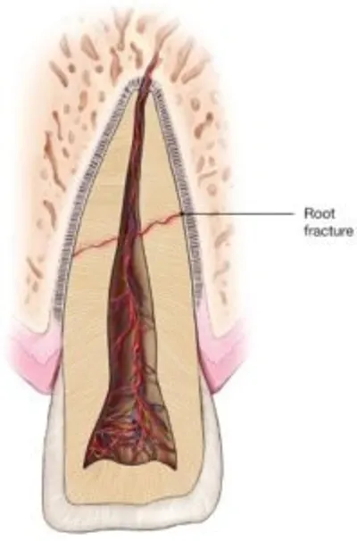 A picture of the inside of a tooth.