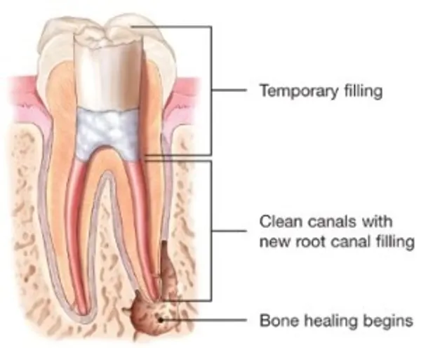 A cross section of the tooth shows where the root canal is filling.