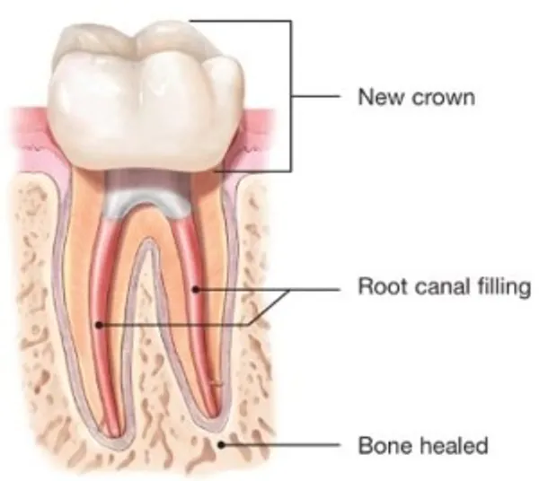 A cross section of the tooth shows new crown, root canal filling and bone healed.
